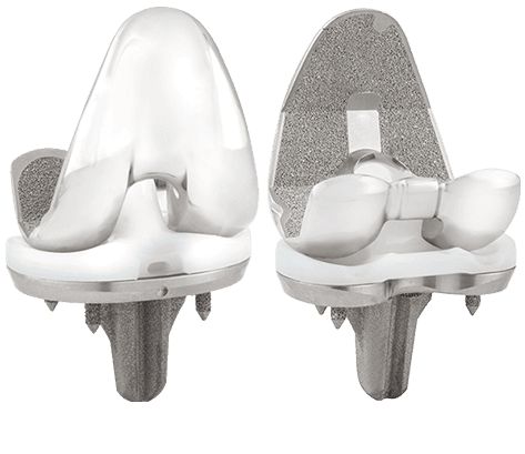 Truliant Porous Knee