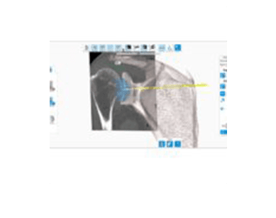 Equinoxe Shoulder Planning App