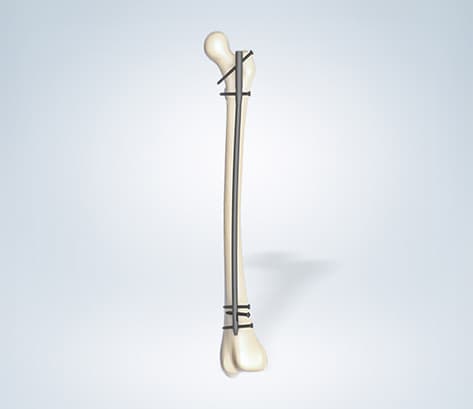 SL-Femur Nail