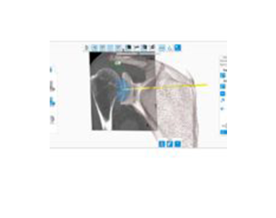 Equinoxe Shoulder Planning App