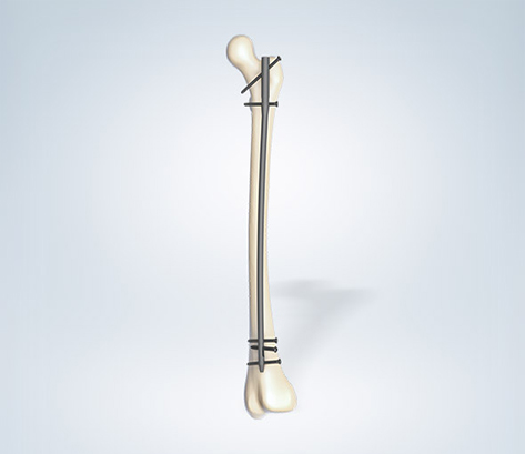 SL-Femur Nail