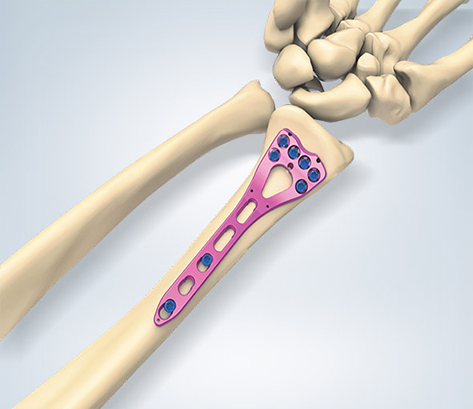 Valp – Distal Radius System